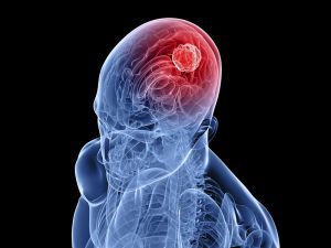 Глиома головного мозга: лечение, прогноз, симптомы, признаки, причины