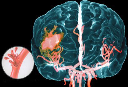 Геморрагический инсульт головного мозга, лечение, симптомы, причины