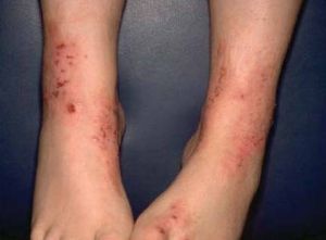 Дерматит на ногах: лечение, симптомы, причины, признаки