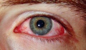 Синдром красного глаза: лечение