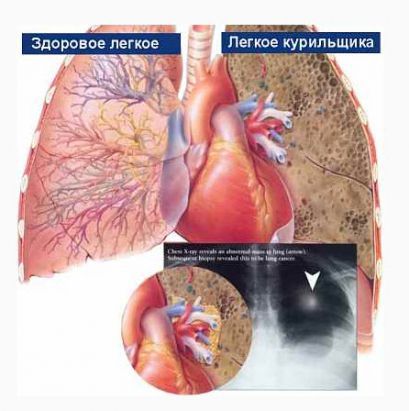 Рак бронхов и легких, лечение, симптомы, причины