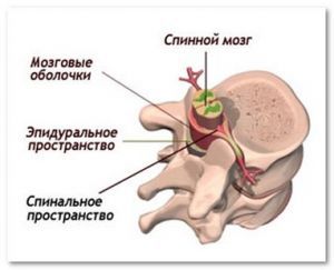 Спинальный эпидуральный абсцесс: лечение, причины, профилактика, симптомы, признаки