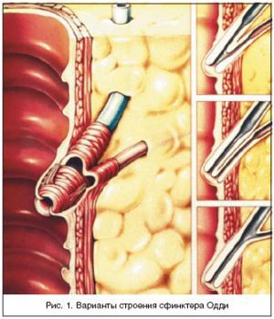 Дисфункция сфинктера Одди: что это такое, лечение, симптомы, признаки, причины