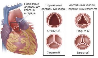 Стеноз устья аорты