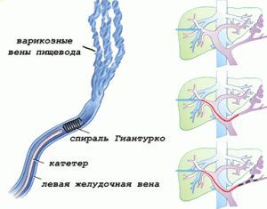 Кровотечение из варикозно расширенных вен пищевода: что это такое, остановка, лечение, признаки, симптомы