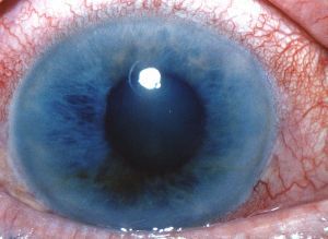 Глаукома глаза: народное лечение, симптомы, причины, профилактика, признаки, стадии, диагностика