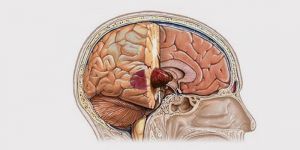 Опухоли головного мозга: симптомы, признаки, лечение, причины, стадии, диагностика, классификация, что это такое