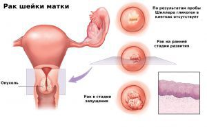 Микроинвазивный рак шейки матки: лечение, прогноз, симптомы, признаки, причины