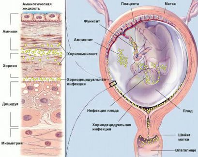 Внутриутробные инфекции у новорожденного: причины, лечение, последствия, симптомы, признаки