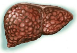 Декомпенсированный цирроз печени: лечение, прогноз, симптомы, признаки, причины