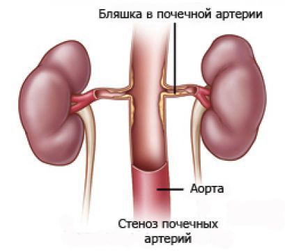 Тромбоз почечных артерий