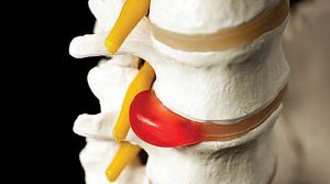 Грыжа позвоночного диска: лечение, симптомы, признаки, причины