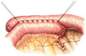 Изменение анатомии желудочно-кишечного тракта в результате хирургических вмешательств. Анастомозы