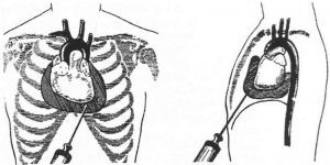 Пункция перикарда: техника, показания