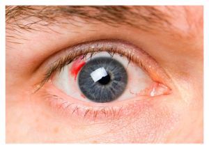 Диабетическая ретинопатия: симптомы, лечение, стадии, осложнения