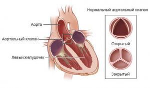 Острое нарушение функции клапанов сердца