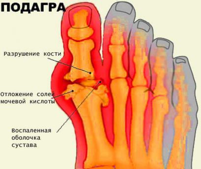 Подагра: что это такое, лечение, симптомы, признаки, причины