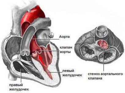 Стеноз аорты, устья, лечение, причины, симптомы, признаки