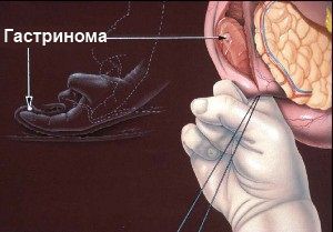 Гастринома: симптомы, признаки, причины, лечение