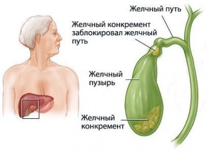 Желчнокаменная диспепсия