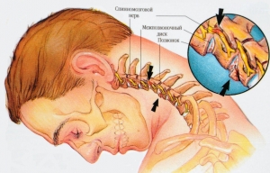 Заболевания шейного отдела позвоночника: причины, лечение, симптомы, признаки