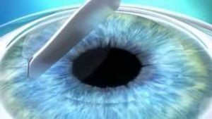 Рефракционная хирургия глаза: что это?