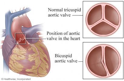 Недостаточность клапанов аорты, аортального клапана