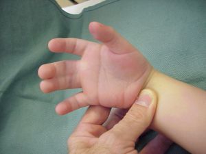 Синдактилия пальцев руки: причины, симптомы, лечение, признаки
