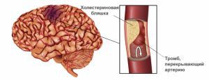 Транзиторная ишемическая атака: симптомы, лечение, последствия