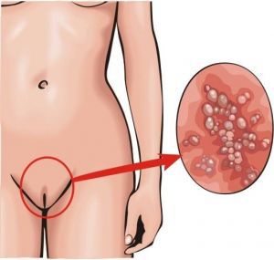 Кандидозный вагинит: лечение, симптомы, причины, признаки