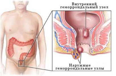 Геморрой, лечение, симптомы, признаки, причины