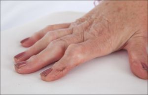 Ревматоидный артрит пальцев рук: симптомы, лечение, причины, признаки