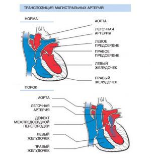 Транспозиция магистральных артерий: причины, операция, лечение, симптомы, признаки