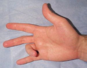Восстановление сухожилий сгибателей пальца