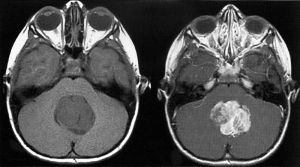 Опухоль головного мозга у детей: симптомы, признаки, причины, лечение