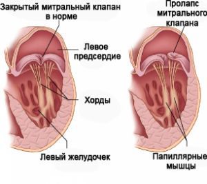 Митральная недостаточность сердца: лечение, симптомы, причины, признаки