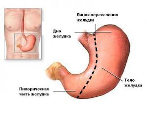 Осложнения резекции желудка и гастрэктомии