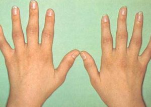 Артрит пястно фалангового сустава кисти руки: лечение, симптомы, признаки, причины