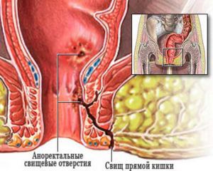 Аноректальный абсцесс: что это такое, лечение, симптомы, причины, признаки