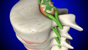 Повреждения спинного мозга: причины, признаки, симптомы, лечение