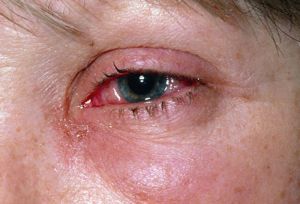 Ушибы и ранения глаз: лечение, первая помощь, причины, симптомы, признаки
