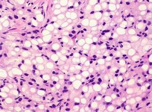 Папиллярный плоско-переходноклеточный рак: лечение, причины, симптомы, признаки