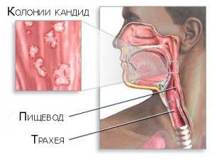 Эзофагит пищевода: что это такое, лечение, симптомы, признаки, причины