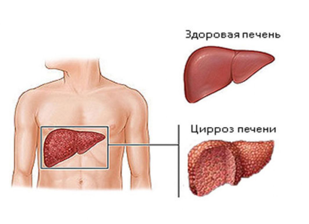 Причина Похудения При Циррозе Печени