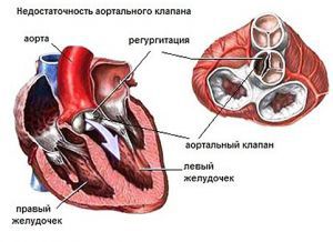 Синдромы недостаточности сердца и сосудов