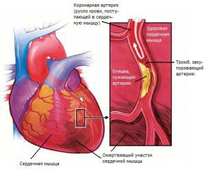 Инфаркт миокарда: что это такое, лечение, симптомы, причины, признаки, профилактика