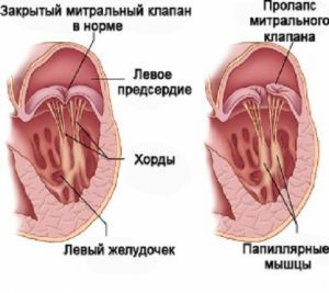 Пролапс митрального клапана, степени, симптомы, лечение, причины, признаки