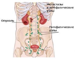 Метастазы без первичного очага: прогноз, симптомы, стадии, лечение