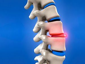 Консервативное лечение спины: воздействие на костную систему