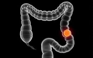 Колоректальный рак: симптомы, лечение, стадии, причины, признаки